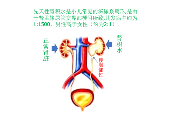 胎儿输尿管狭窄怎么办(输尿管狭窄导致肾积水的治疗方法) 第2张 胎儿输尿管狭窄怎么办(输尿管狭窄导致肾积水的治疗方法) 第2张