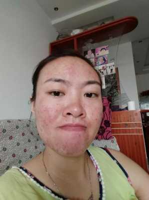 怀孕期间长痘痘怎么治(怀孕期间长痘痘怎么治疗) 第1张 怀孕期间长痘痘怎么治(怀孕期间长痘痘怎么治疗) 第1张