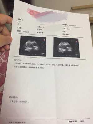 有没有孕期一直出血的(怀孕8周多每天都有出一点点的血,去医院检查胎心胎芽都正常) 第3张 有没有孕期一直出血的(怀孕8周多每天都有出一点点的血,去医院检查胎心胎芽都正常) 第3张