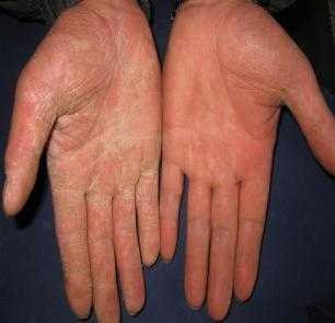 怀孕期间有手癣怎么办(怀孕期间有手癣怎么办啊) 第2张 怀孕期间有手癣怎么办(怀孕期间有手癣怎么办啊) 第2张