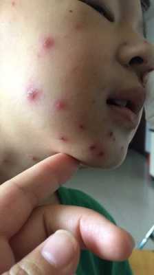 怀孕期间长水痘怎么办(怀孕期间长水痘怎么办啊) 第2张 怀孕期间长水痘怎么办(怀孕期间长水痘怎么办啊) 第2张