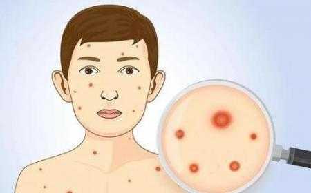 怀孕期间长水痘怎么办(怀孕期间长水痘怎么办啊) 第1张 怀孕期间长水痘怎么办(怀孕期间长水痘怎么办啊) 第1张