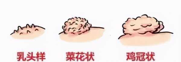 怀孕期间怎么会尖锐湿(怀孕期间怎么会尖锐湿长了一颗) 第2张 怀孕期间怎么会尖锐湿(怀孕期间怎么会尖锐湿长了一颗) 第2张