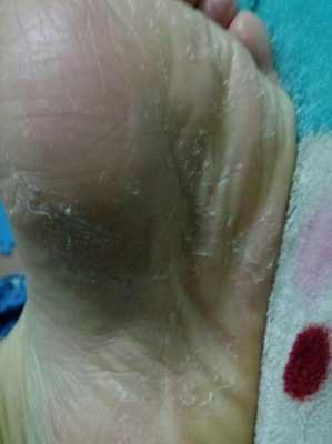 怀孕期间脚气严重怎么办(孕妇有脚气怎么办,特痒,孕妇有脚气怎么) 第2张 怀孕期间脚气严重怎么办(孕妇有脚气怎么办,特痒,孕妇有脚气怎么) 第2张