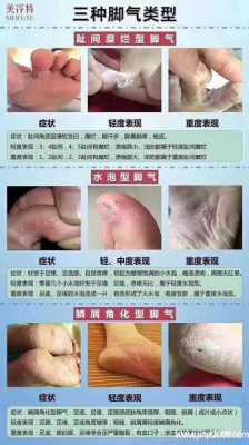 怀孕期间有脚气怎么治（怀孕期间有脚气怎么治疗好）  第3张
