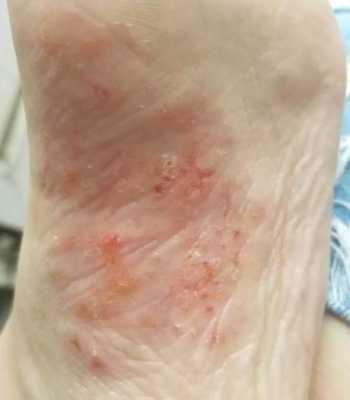 孕期脚气犯了脚趾缝痒怎么办(请问孕妇怀孕八个月的时候脚趾缝里面痒怎么办啊?是不是得了脚气) 第1张 孕期脚气犯了脚趾缝痒怎么办(请问孕妇怀孕八个月的时候脚趾缝里面痒怎么办啊?是不是得了脚气) 第1张