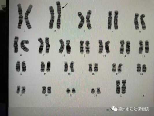 15号染色体缺失会怎样,胎儿15号染色体异常会怎样 第2张 15号染色体缺失会怎样,胎儿15号染色体异常会怎样 第2张