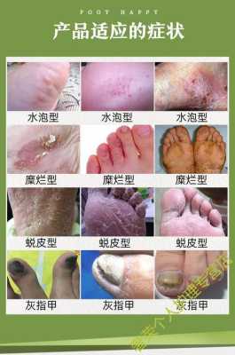 怀孕期间烂脚丫怎么办(怀孕期间烂脚丫怎么办啊) 第2张 怀孕期间烂脚丫怎么办(怀孕期间烂脚丫怎么办啊) 第2张