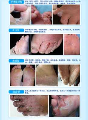 怀孕期间烂脚丫怎么办(怀孕期间烂脚丫怎么办啊) 第1张 怀孕期间烂脚丫怎么办(怀孕期间烂脚丫怎么办啊) 第1张