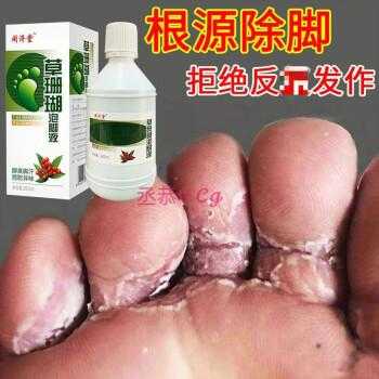 怀孕期间脚气痒怎么办(怀孕期间脚气痒怎么办用什么药) 第1张 怀孕期间脚气痒怎么办(怀孕期间脚气痒怎么办用什么药) 第1张