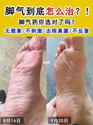 怀孕期间脚气痒怎么办(怀孕期间脚气痒怎么办用什么药) 第2张 怀孕期间脚气痒怎么办(怀孕期间脚气痒怎么办用什么药) 第2张