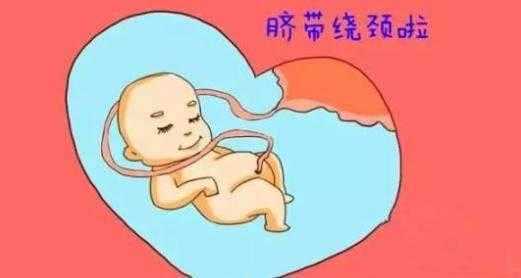 胎儿脐带绕颈三周图片（脐带绕颈三周可以顺产吗）  第2张