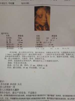 胎儿头部囊肿会自己消失吗(四维彩超胎儿脑部囊肿怎么办) 第2张 胎儿头部囊肿会自己消失吗(四维彩超胎儿脑部囊肿怎么办) 第2张