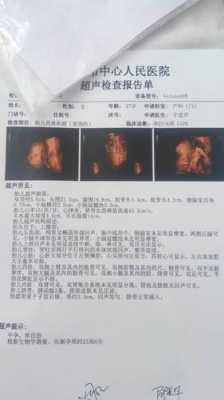 孕期可以做两次四维吗（孕期可以做两次四维吗）  第1张
