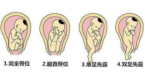胎儿如果是臀位怎么办,孕妇臀位对胎儿有影响吗 第2张 胎儿如果是臀位怎么办,孕妇臀位对胎儿有影响吗 第2张