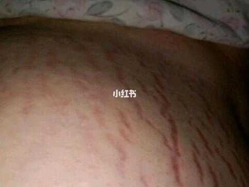 孕期没长妊娠纹生完会有吗（为什么有的女人没有妊娠纹）  第2张