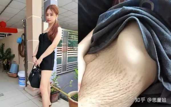 孕期没长妊娠纹生完会有吗（为什么有的女人没有妊娠纹）  第3张