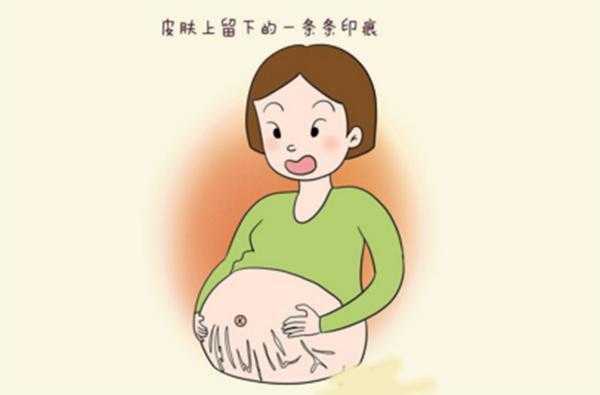 怀孕期间妊娠纹怎样能消除(怀孕期间妊娠纹怎样能消除掉) 第3张 怀孕期间妊娠纹怎样能消除(怀孕期间妊娠纹怎样能消除掉) 第3张
