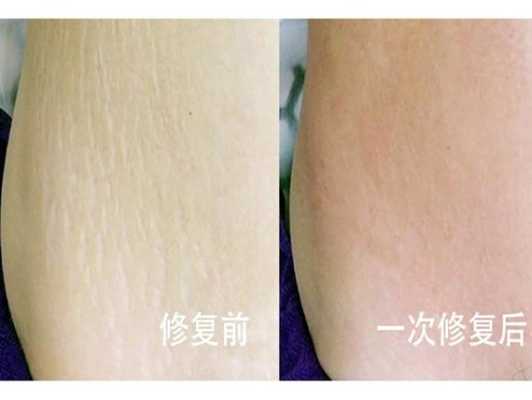 怀孕期间妊娠纹怎样能消除(怀孕期间妊娠纹怎样能消除掉) 第1张 怀孕期间妊娠纹怎样能消除(怀孕期间妊娠纹怎样能消除掉) 第1张