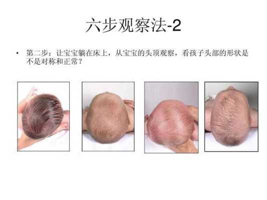 胎儿头扁是什么原因(胎儿头扁是什么原因造成的) 第2张 胎儿头扁是什么原因(胎儿头扁是什么原因造成的) 第2张