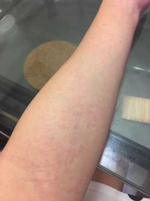 怀孕了为什么身上很痒怎么办,怀孕期间皮肤痒怎么办啊 第3张 怀孕了为什么身上很痒怎么办,怀孕期间皮肤痒怎么办啊 第3张