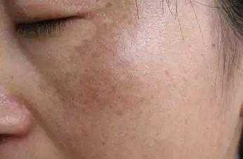 怀孕期间脸上长斑是什么原因(怀孕期间脸上长斑是什么原因) 第2张 怀孕期间脸上长斑是什么原因(怀孕期间脸上长斑是什么原因) 第2张