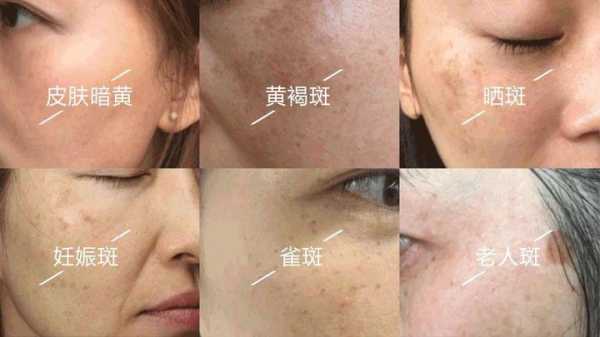 怀孕期间脸上长斑是什么原因(怀孕期间脸上长斑是什么原因) 第1张 怀孕期间脸上长斑是什么原因(怀孕期间脸上长斑是什么原因) 第1张