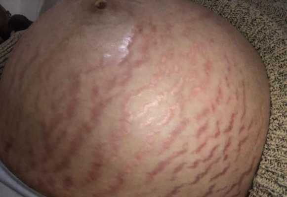 怀孕期间妊娠纹痒怎么办(怀孕期间妊娠纹痒怎么办呢) 第3张 怀孕期间妊娠纹痒怎么办(怀孕期间妊娠纹痒怎么办呢) 第3张