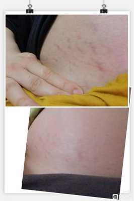 怀孕期间妊娠纹痒怎么办(怀孕期间妊娠纹痒怎么办呢) 第1张 怀孕期间妊娠纹痒怎么办(怀孕期间妊娠纹痒怎么办呢) 第1张