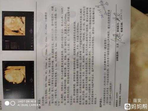 孕妇做四维彩超24周胎儿显示没有胆囊,胎儿没胆囊问题大不大 第2张 孕妇做四维彩超24周胎儿显示没有胆囊,胎儿没胆囊问题大不大 第2张