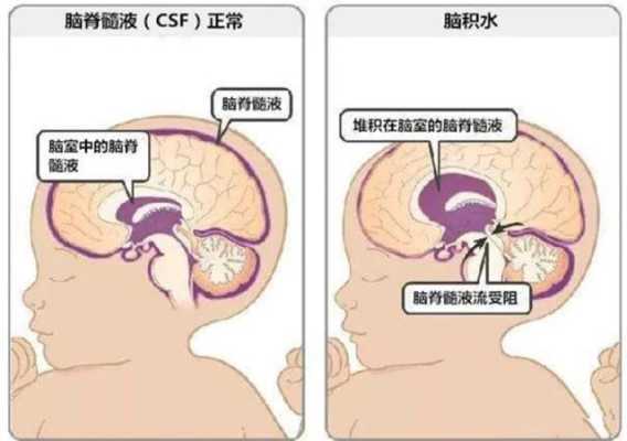 孕妇胎儿脑积水怎么办(孕妇胎儿脑积水怎么办呢) 第1张 孕妇胎儿脑积水怎么办(孕妇胎儿脑积水怎么办呢) 第1张