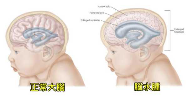 脑硬膜下积液怎么办,胎儿脑内积水怎么办36周  第2张
