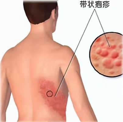 孕妇得了疱疹怎么办,孕期疱疹对胎儿有影响吗 第3张 孕妇得了疱疹怎么办,孕期疱疹对胎儿有影响吗 第3张