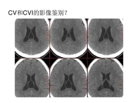 什么是第五第六脑室形成,胎儿第六脑室形成有什么危害 第1张 什么是第五第六脑室形成,胎儿第六脑室形成有什么危害 第1张