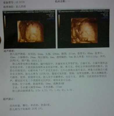 彩超测胎儿体重准吗(彩超测胎儿体重准吗准确吗) 第2张 彩超测胎儿体重准吗(彩超测胎儿体重准吗准确吗) 第2张