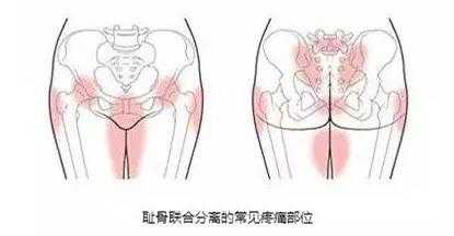孕妇耻骨疼怎么回事,孕期耻骨疼,耻骨是哪个部位图片 第2张 孕妇耻骨疼怎么回事,孕期耻骨疼,耻骨是哪个部位图片 第2张