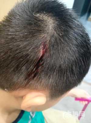 小孩头部皮下囊肿怎么治疗,胎儿头部有囊肿怎么办呢 第2张 小孩头部皮下囊肿怎么治疗,胎儿头部有囊肿怎么办呢 第2张