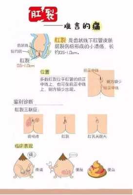 孕期肛裂（孕期肛裂）  第1张