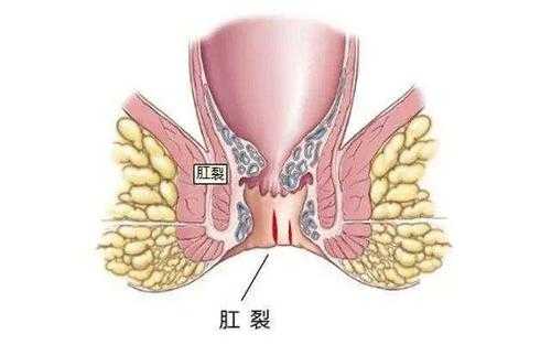 孕期肛裂（孕期肛裂）  第2张