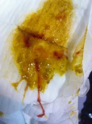 孕期血丝(孕妇便血怎么办,这是什么原因造成呢) 第3张 孕期血丝(孕妇便血怎么办,这是什么原因造成呢) 第3张