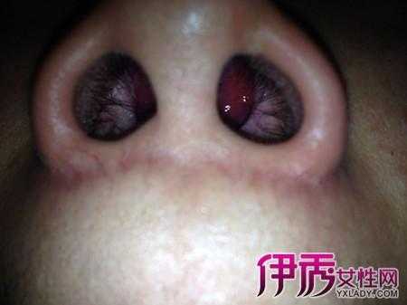 孕期息肉(孕期鼻息肉怎么办) 第2张 孕期息肉(孕期鼻息肉怎么办) 第2张