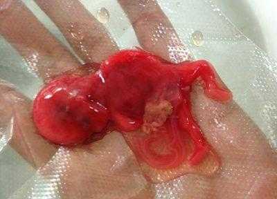 孕期流产(孕期流产症状有哪些) 第2张 孕期流产(孕期流产症状有哪些) 第2张