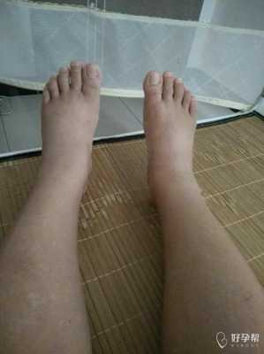 孕期腿脚浮肿(孕妇脚水肿怎么办) 第3张 孕期腿脚浮肿(孕妇脚水肿怎么办) 第3张