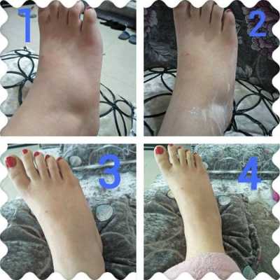 孕期腿脚浮肿(孕妇脚水肿怎么办) 第1张 孕期腿脚浮肿(孕妇脚水肿怎么办) 第1张