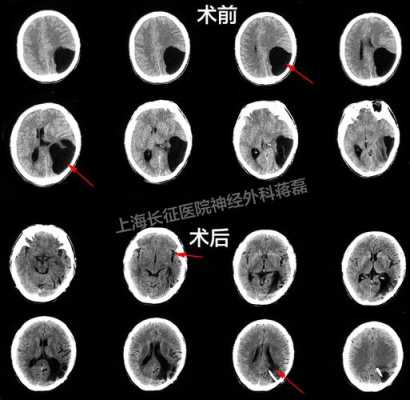 胎儿蛛网膜囊肿能要吗(胎儿蛛网膜囊肿该不该生下来) 第2张 胎儿蛛网膜囊肿能要吗(胎儿蛛网膜囊肿该不该生下来) 第2张