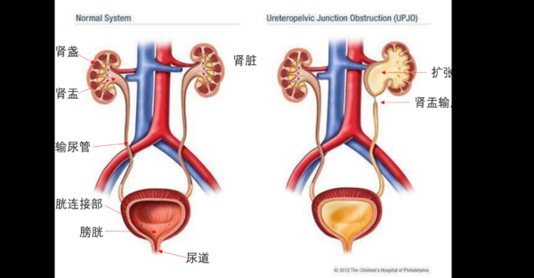 胎儿双肾积水怎么回事(双肾积水怎么治) 第1张 胎儿双肾积水怎么回事(双肾积水怎么治) 第1张