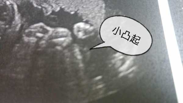 胎儿两腿之间有亮点(胎儿两腿之间有亮点是男孩吗) 第2张 胎儿两腿之间有亮点(胎儿两腿之间有亮点是男孩吗) 第2张