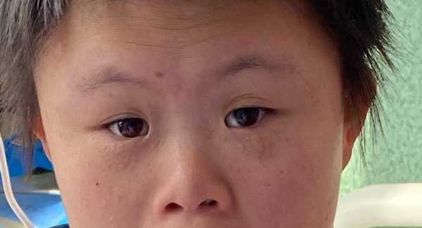 宝宝眼距宽是怎么回事,胎儿眼距正常值范围是多少 第2张 宝宝眼距宽是怎么回事,胎儿眼距正常值范围是多少 第2张