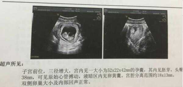 fl指胎儿的什么意思(fl指的是胎儿什么意思) 第3张 fl指胎儿的什么意思(fl指的是胎儿什么意思) 第3张