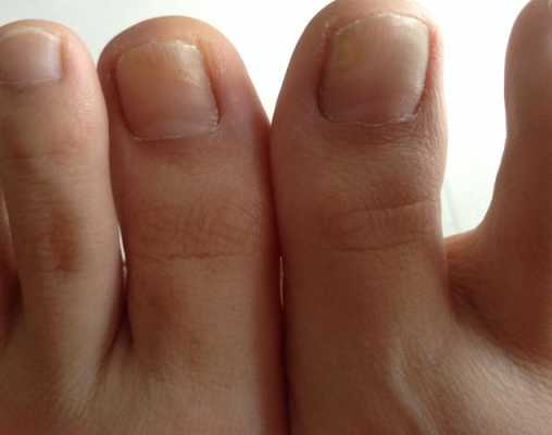 孕期指甲发黄(孕期指甲发黄是什么原因) 第3张 孕期指甲发黄(孕期指甲发黄是什么原因) 第3张